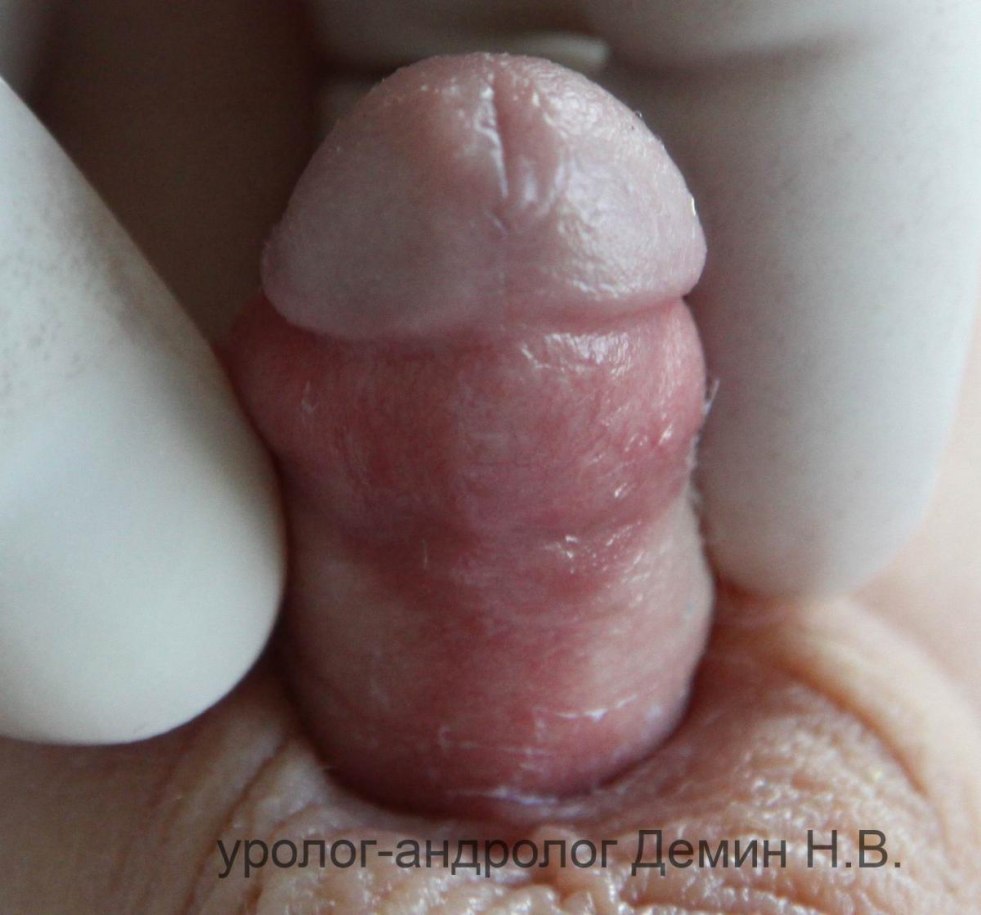 Hole in the penis head