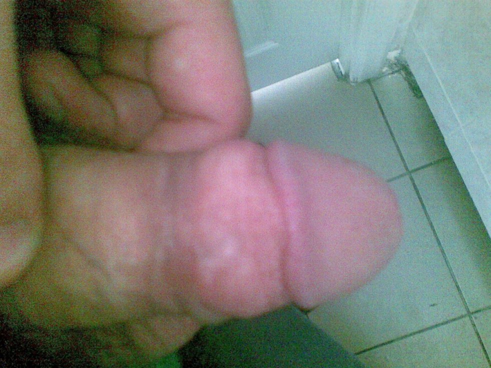 Swollen dick after bite bee