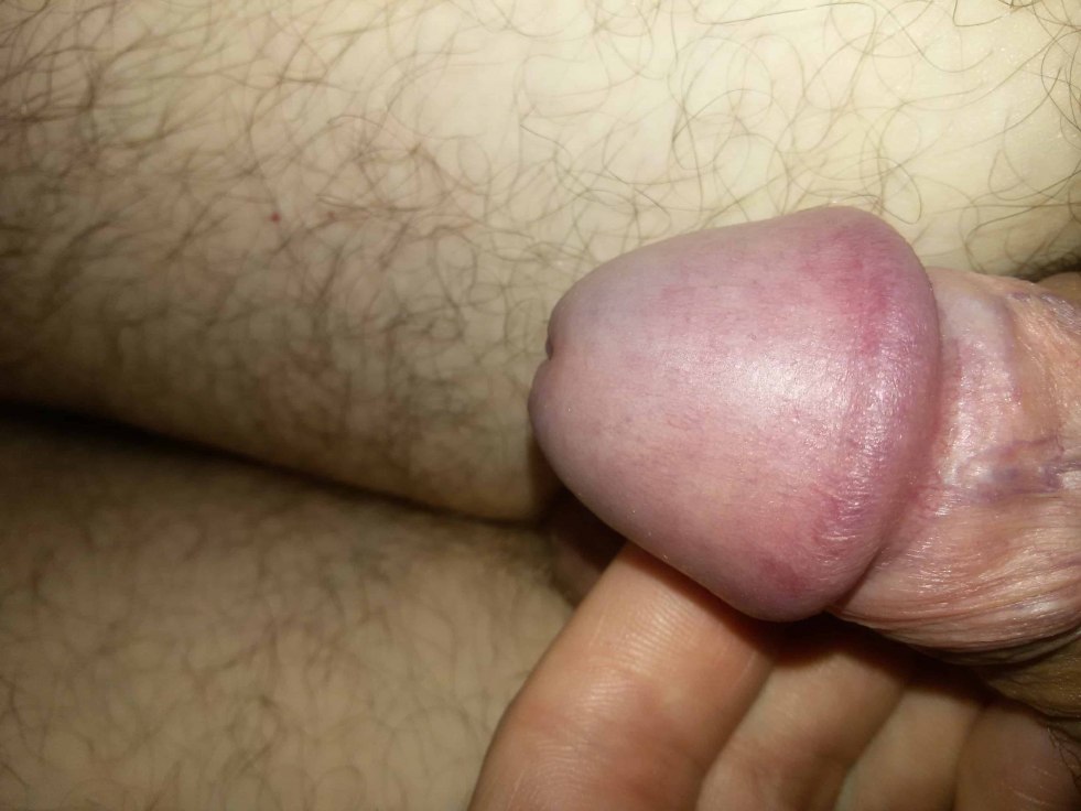 Hair on the penis head