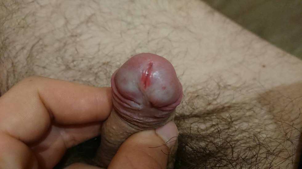 Redness of the extreme Penis flesh