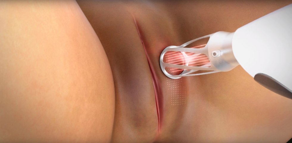 Naked woman at the gynecologist