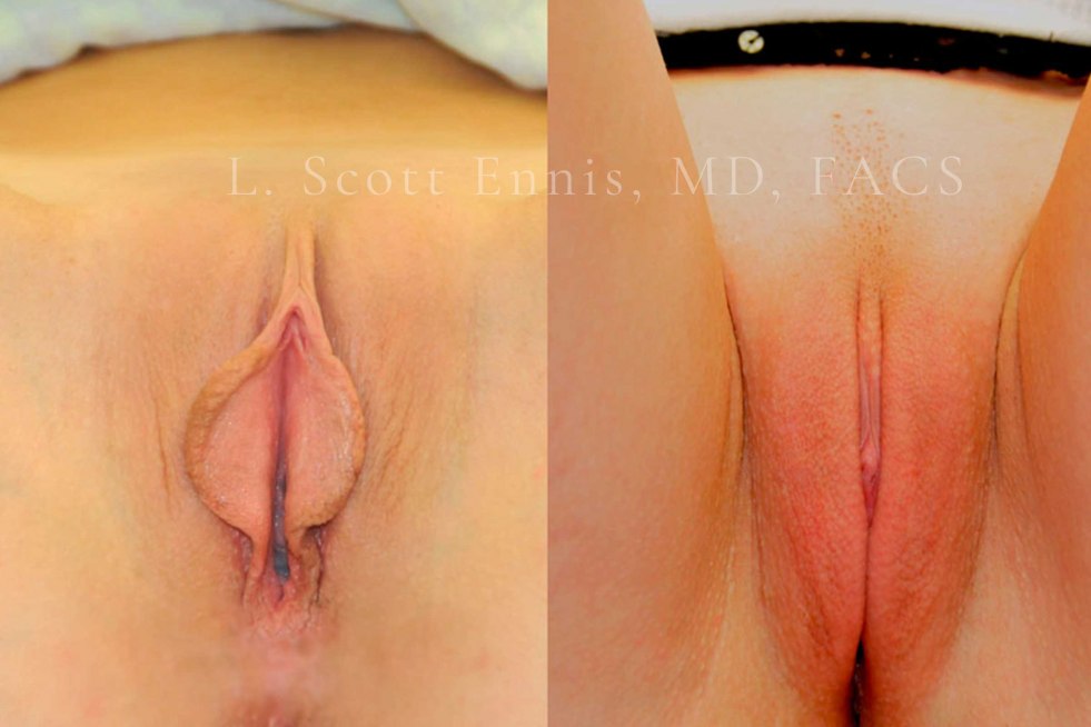 Male and female anus