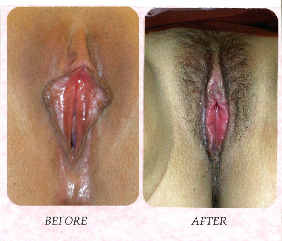 Vaginal repair before and after