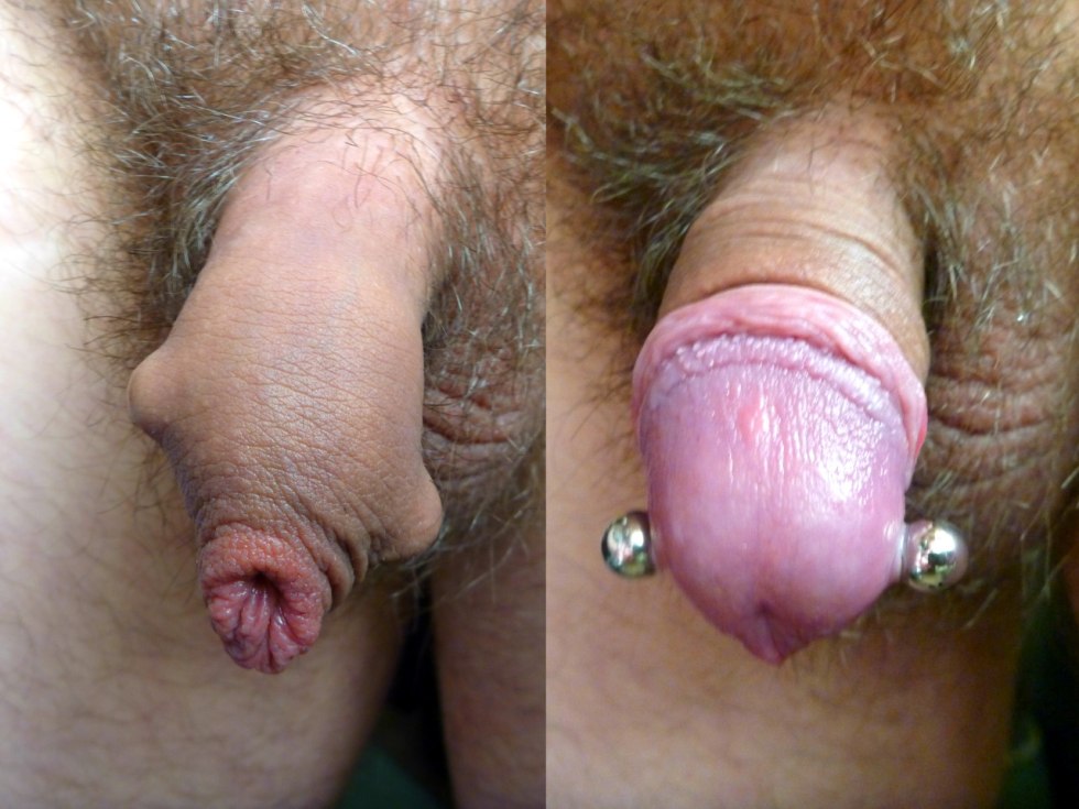Male intimate piercing of a member
