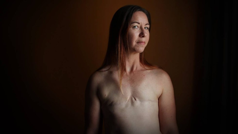 Women after mastectomy